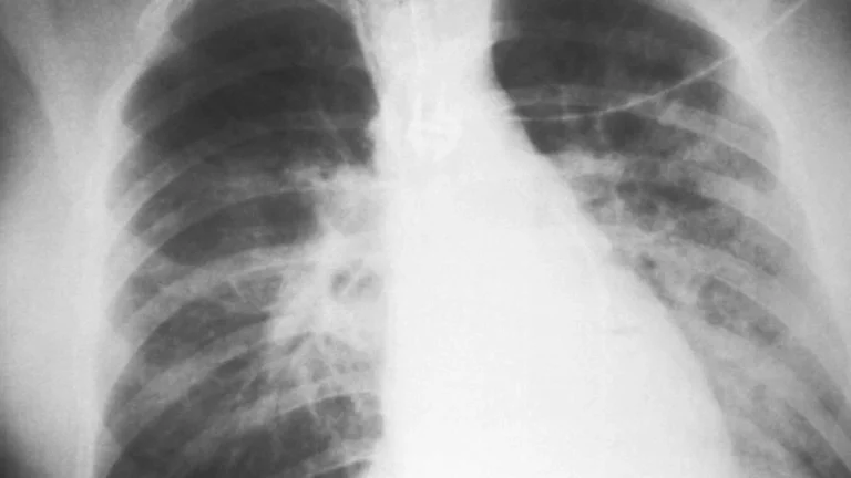 What is lung adenocarcinoma, the cancer diagnosed in Pope Leo?