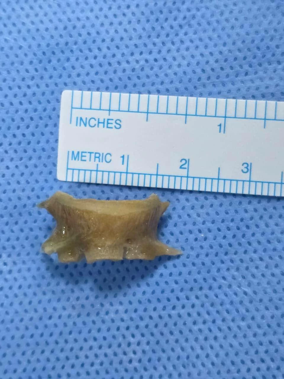 Fish bone measuring 2 cm removed from patient’s airway after two months of suffering
