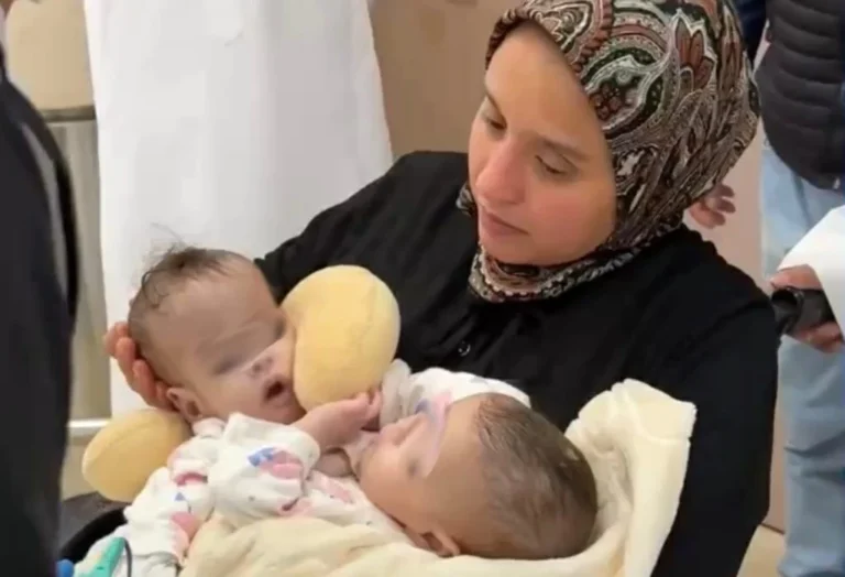 في وقت قياسي وبسلاسة تامة.. نجاح عملية فصل التوأم المغربي سجى وضحى