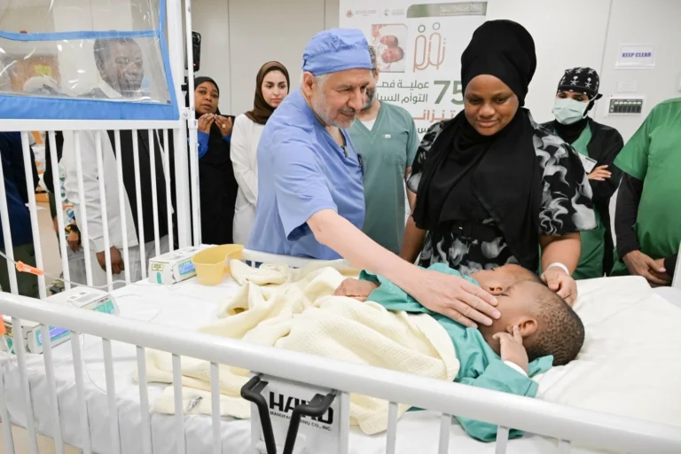 بدء عملية فصل التوأم الملتصق التنزاني (لايتيينس ولوفنس) في الرياض