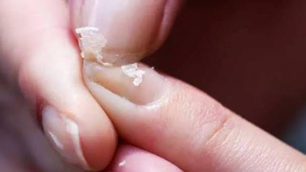 أعراض تكشف وجود نقص بالكالسيوم.. استشاري يوضح