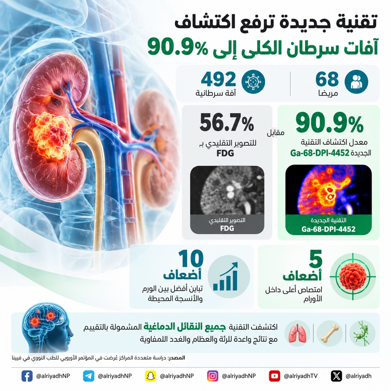 تقنية تصوير جديدة تعزز اكتشاف آفات سرطان الكلى الصافي
