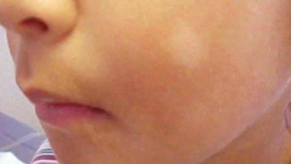 ما نقص الفيتامين الذي يسبب ظهور بقع بيضاء على الجلد؟.. أسباب متعددة وطرق العلاج