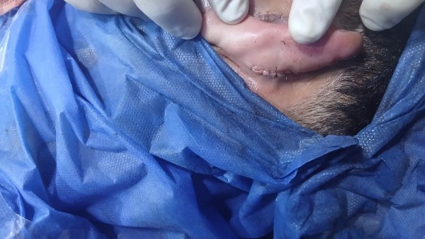 بعد قطع أذنه..مستشفى بلبيس بالشرقية تنجح في إعادة زرع وترميم أذن شاب تعرض لحادث سير