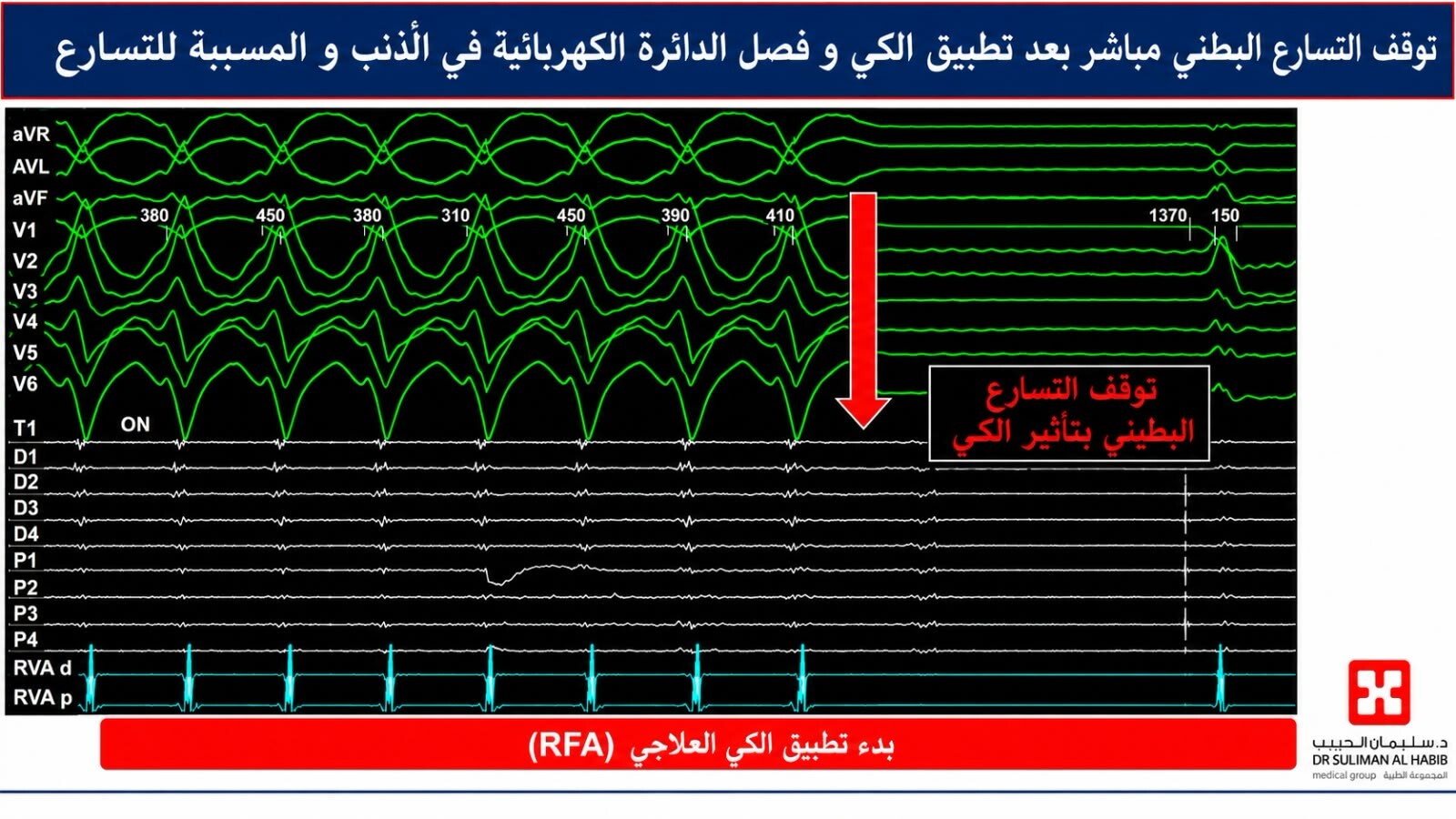مستشفى الدكتور سليمان الحبيب بالصحافة يشهد أول
 استخدام لتقنية «المجال الكهربائي النبضي» لعلاج تسارع القلب البطيني الأيسر بالمملكة