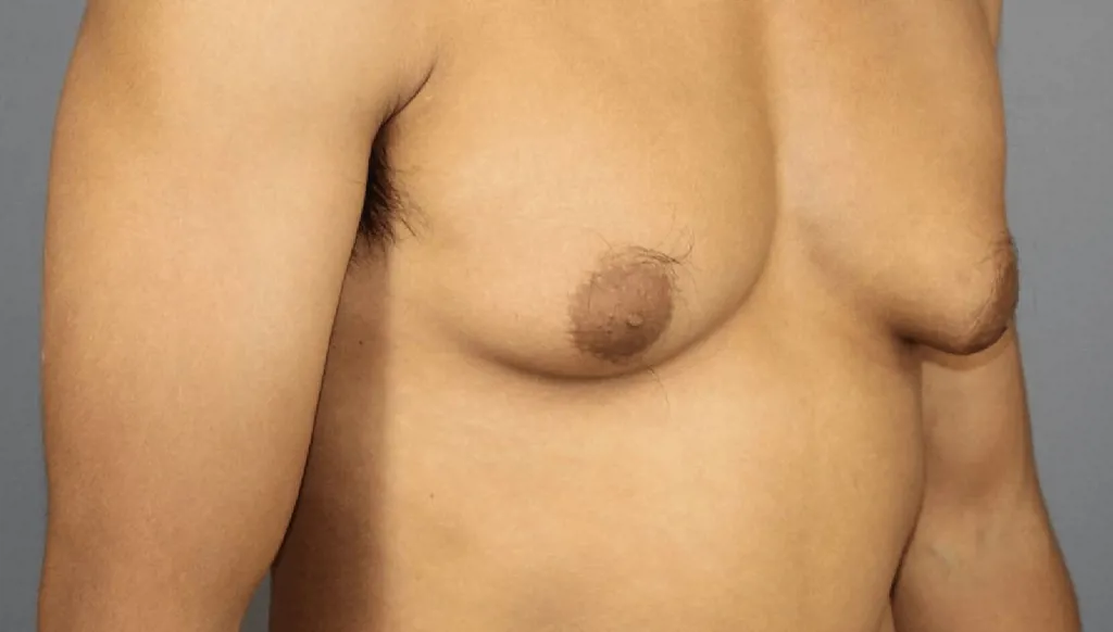 Gynecomastia in men: Causes, warning signs and treatment options