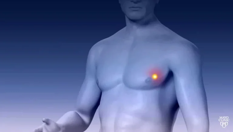 متى يصبح سرطان الثدي لدى الرجل أكثر خطورة؟